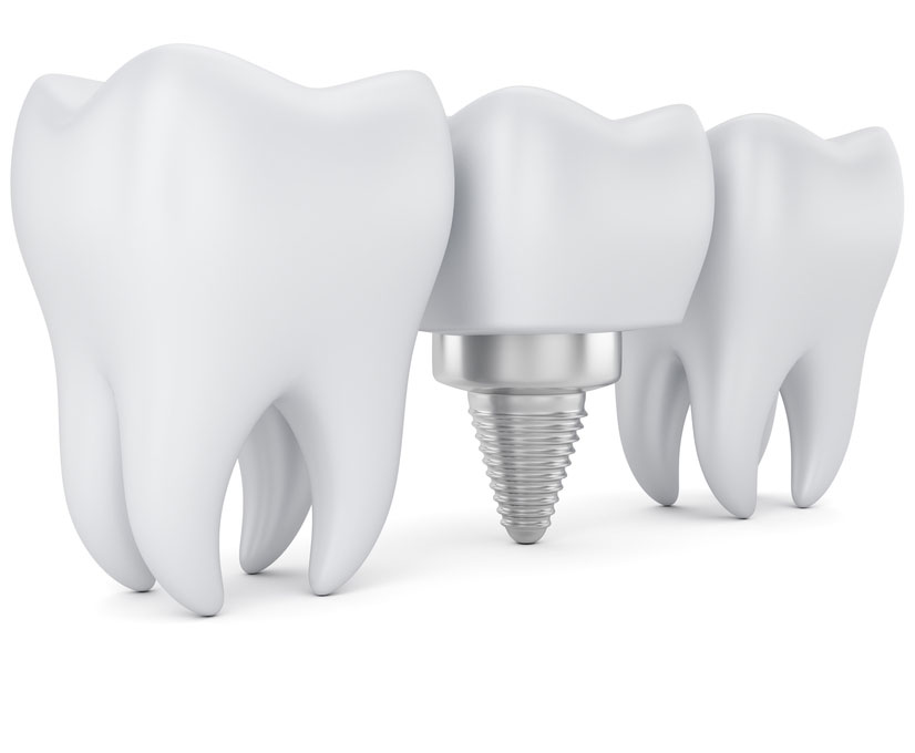 3d dental implant illustration